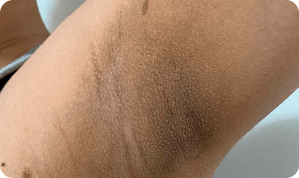 Pele da axila antes do uso do Clear Beauty