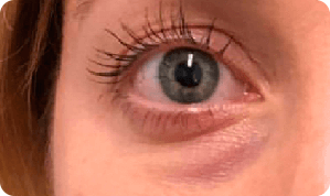 Região dos olhos antes do uso do Clear Beauty
