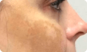 Pele do rosto antes do uso do Clear Beauty