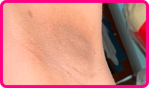 Pele da axila após 28 dias de uso do Clear Beauty