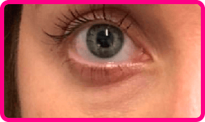 Região dos olhos após 14 dias de uso do Clear Beauty