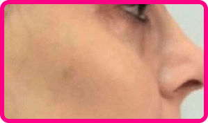 Pele do rosto após 25 dias de uso do Clear Beauty