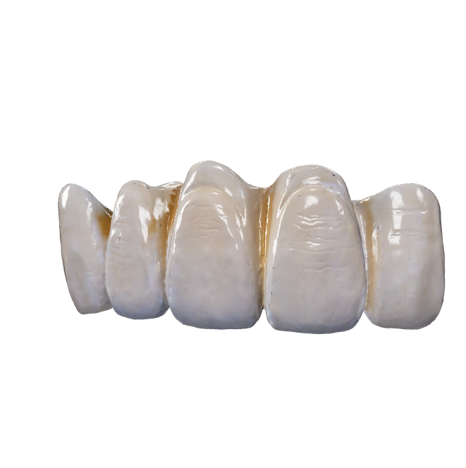 Pmf Inlay PFM Bridges