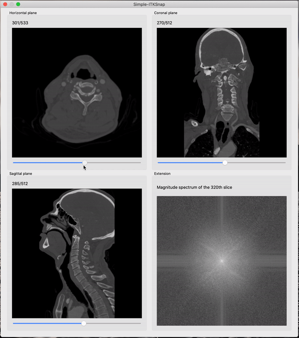 A CTA image opened in simpleITK-Snap