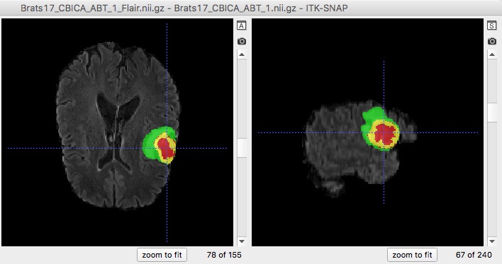 Automatic Brain Tumor Segmentation Using Cascaded Anisotropic ...