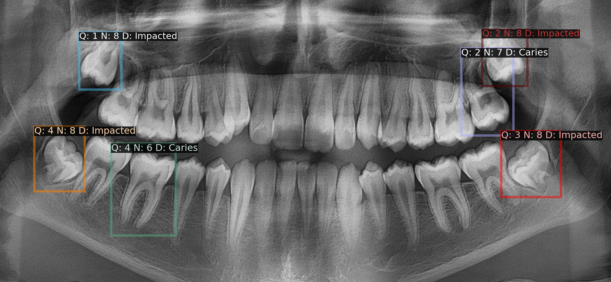 Output from our final model showing well-defined boxes for diseased teeth with corresponding quadrant (Q), enumeration (N), and diagnosis (D) labels., etc.