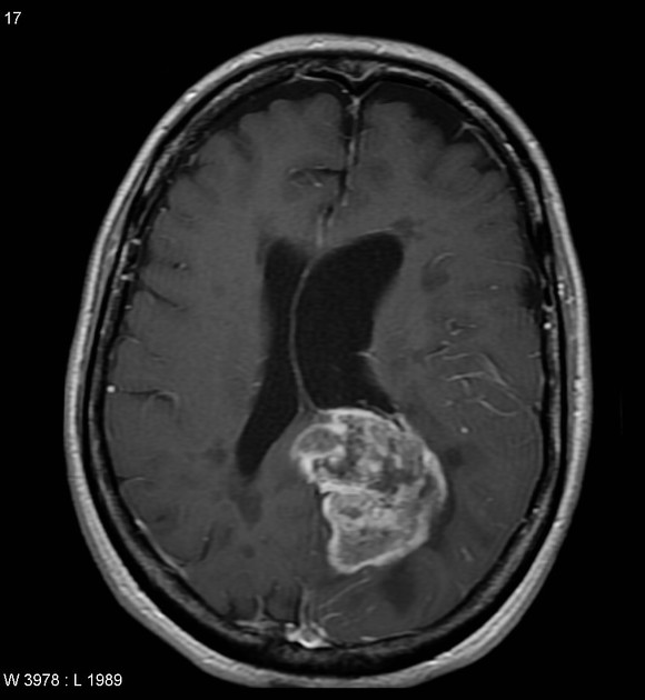 Glioblastoma