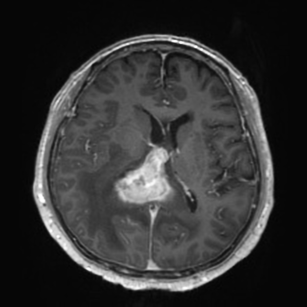 Primary central nervous system lymphoma