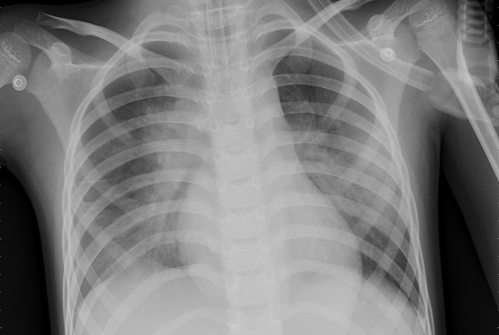 Bacteria Pneumonia Sample