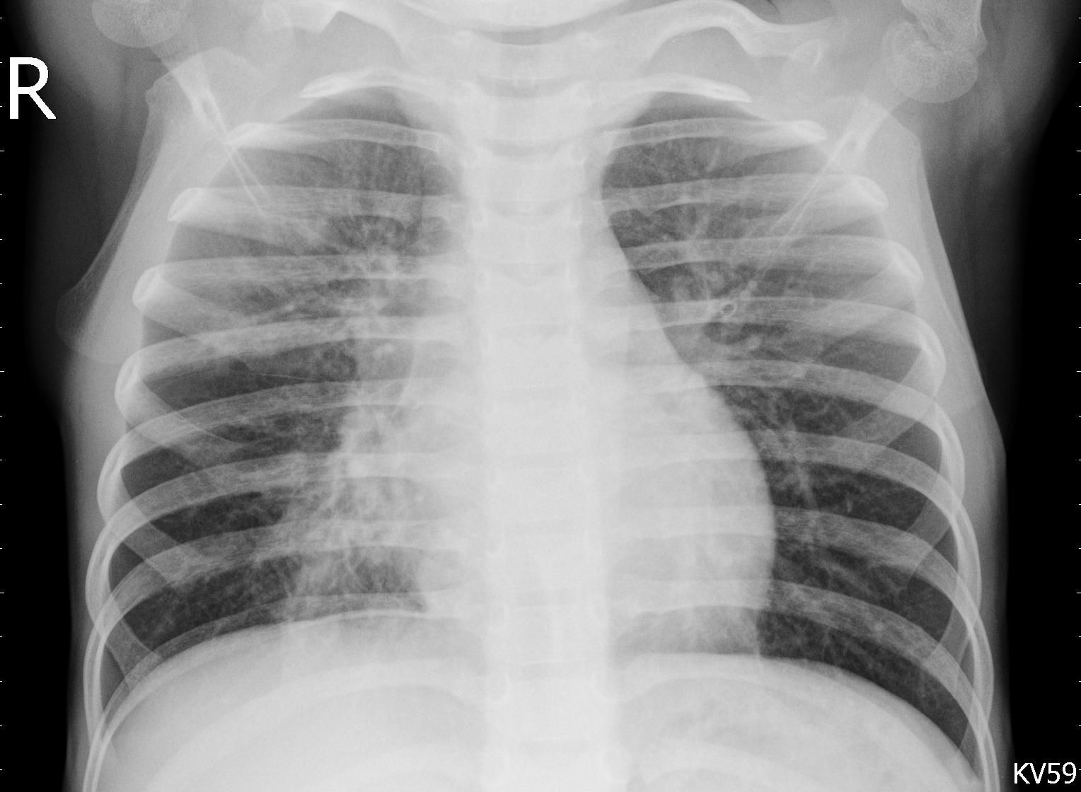 Viral Pneumonia Sample