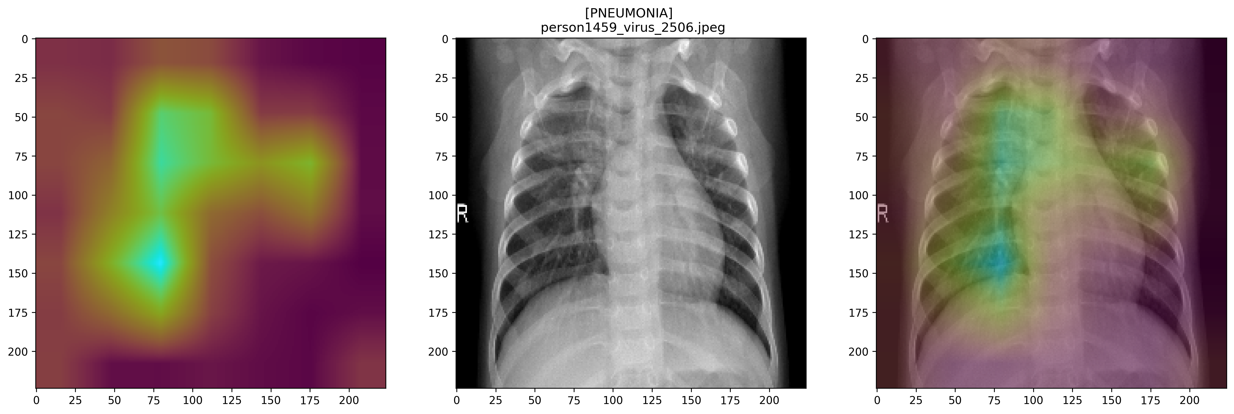 Pneumonia Detection Using Convolutional Neural Network