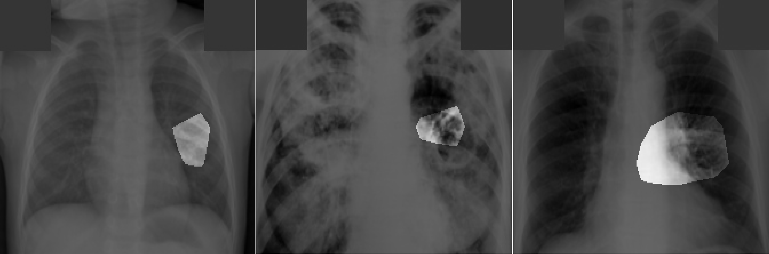 root cause analysis of a tuberculosis sample image