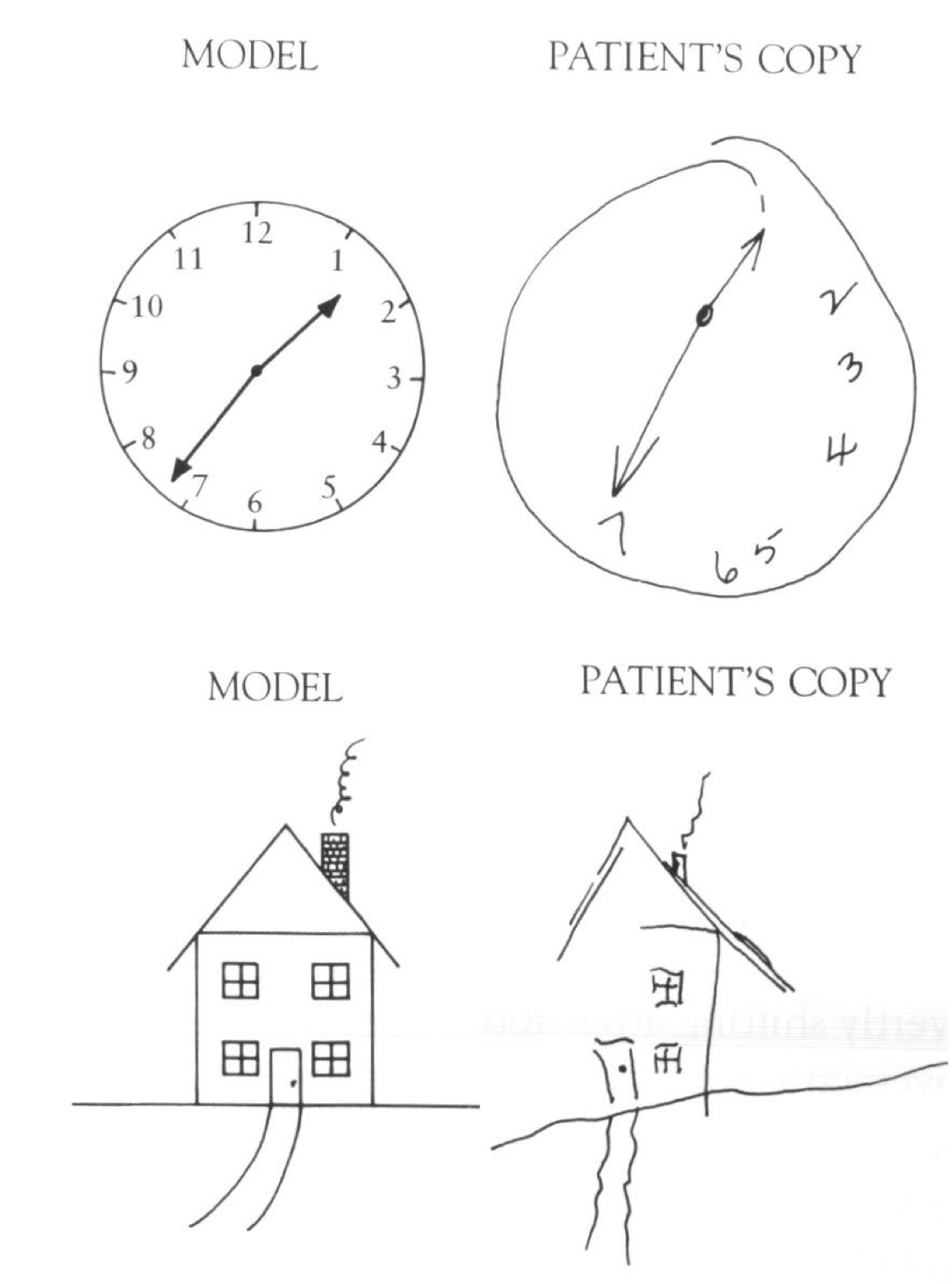 半側空間無視の患者による所定の対象物の描画。図面の左側が著しく無視されていることが示されています。