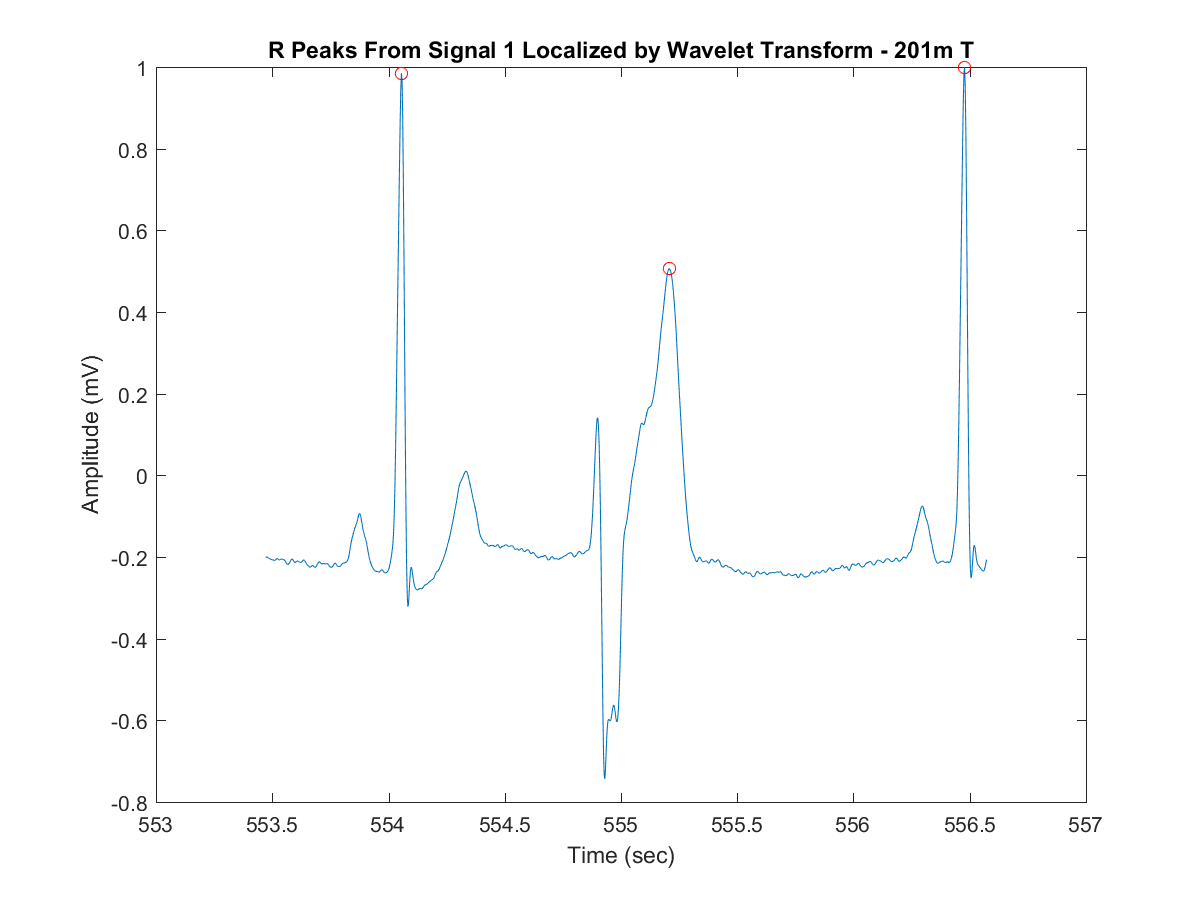 Extracted signal peaks for Trigeminy Ventricular arrhythmia sample transformed with DWT