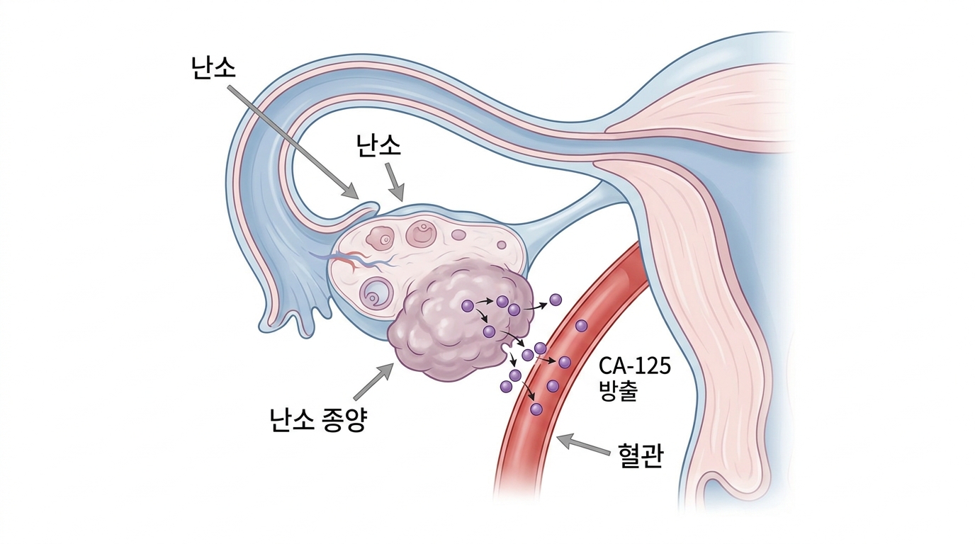 CA 125 (암항원 125)