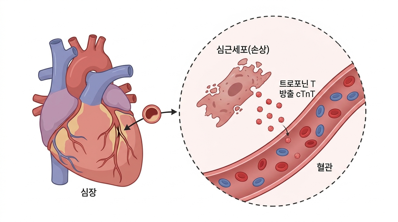 Troponin T (심근트로포닌 T)
