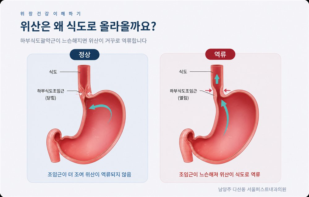 위산은 왜 식도로 올라올까요 - 정상과 역류 비교