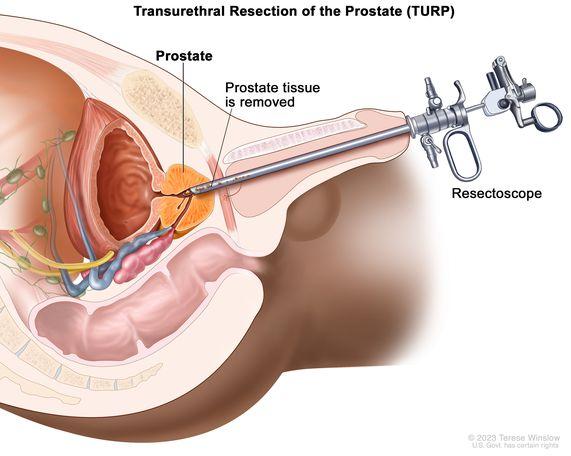 Prostate Surgery (TURP) प्रोस्टेट/ पुरुषग्रन्थीको उपचार