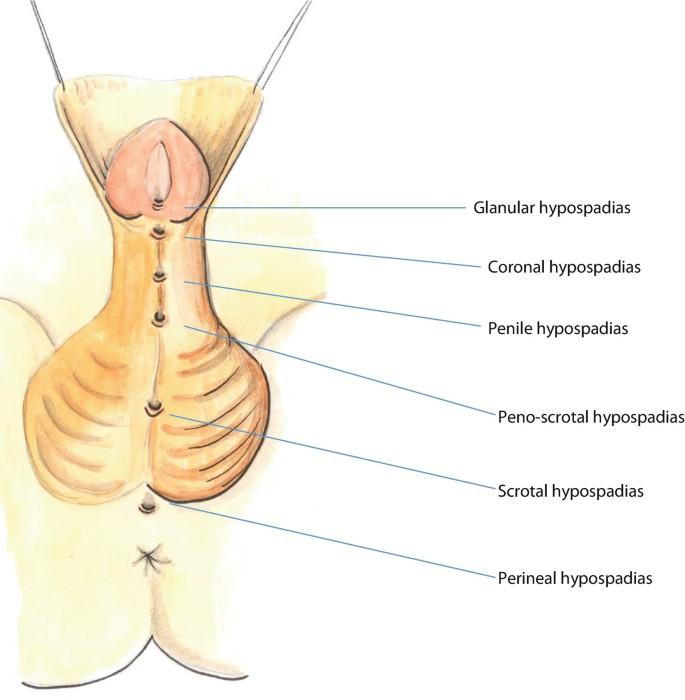 Hypospadius (हाइपोस्पेडियास)