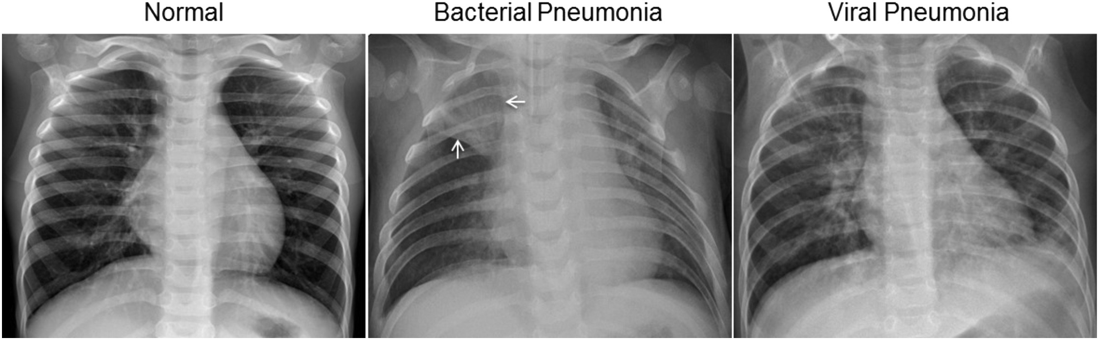 examples-of-chest-X-Rays-in-patients-with-pneumonia