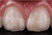 Treatment of Caries with ICON