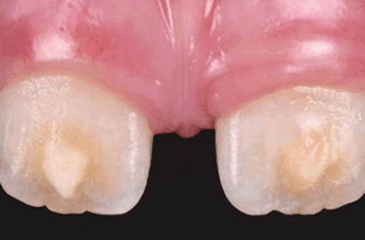 Treatment of Fluorosis with ICON