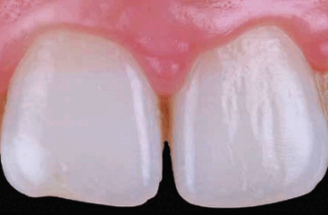 Treatment of Trauma with ICON