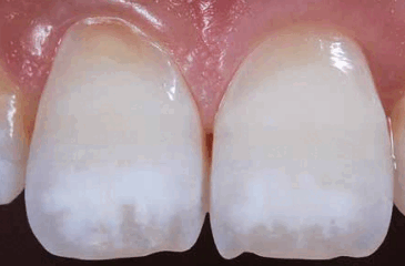Treatment of White Spots with ICON