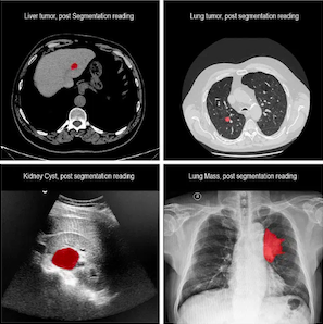 medical image segmentation