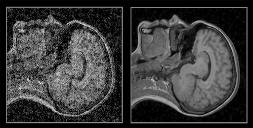 Example of denoising and super resolution in medical imaging