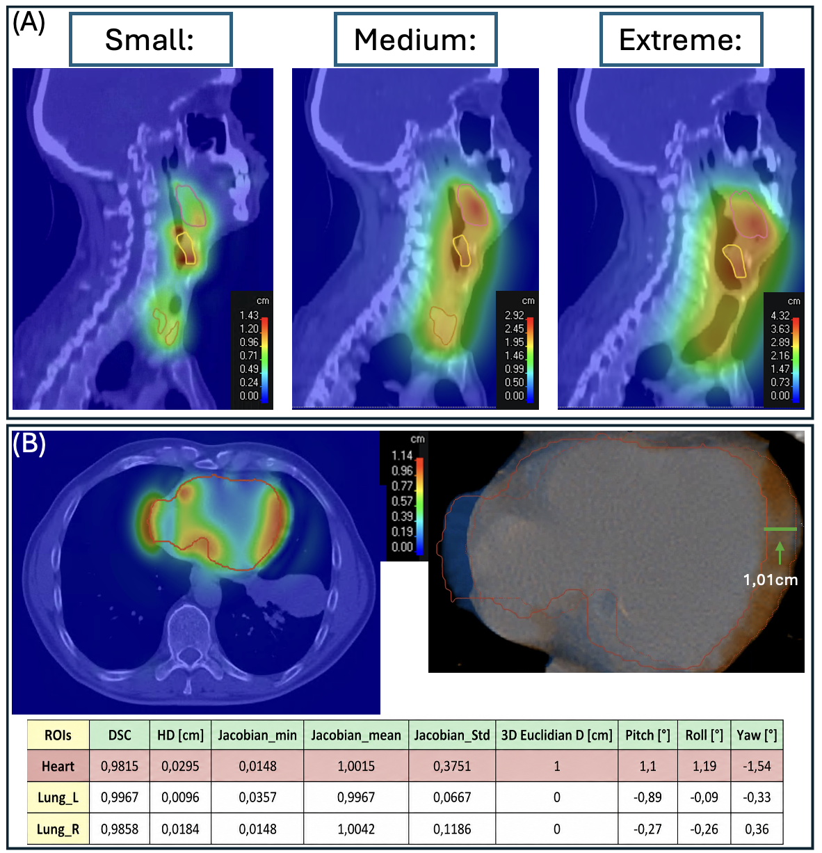 Figure 2: (A) Example of a Head and Neck patient used as input to test the generation of digital phantom. After the autocontouring, three ROIs (Larynx, Thyroid Gland, and Tongue Base) were moved with three different magnitudes (small, medium, and extreme) to test the functionality of the script. (B) Example of detailed validation on a Thorax patient by applying an extreme displacement of 1cm only in Heart in Left-Right axis. The validation was first qualitative by visual inspection of colourwash showing the location of the deformation, followed by quantitative measurements of the distance between the reference and the moved heart structure in the fusion image. Last step was the calculation of the metrics of heart and surrounding ROIs.