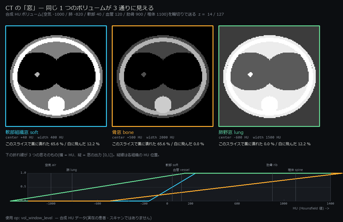 CT の「窓」で同じ体が 3 通りに見える