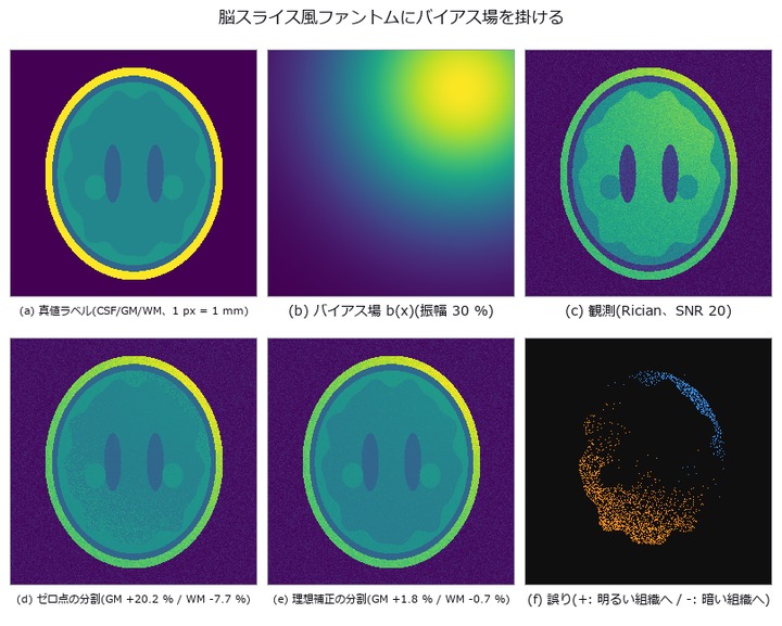 MRI Bias Field and Tissue Area — Grey and White Matter Fail in Opposite Directions, and the Sum Hides It