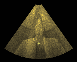 Ultrasound