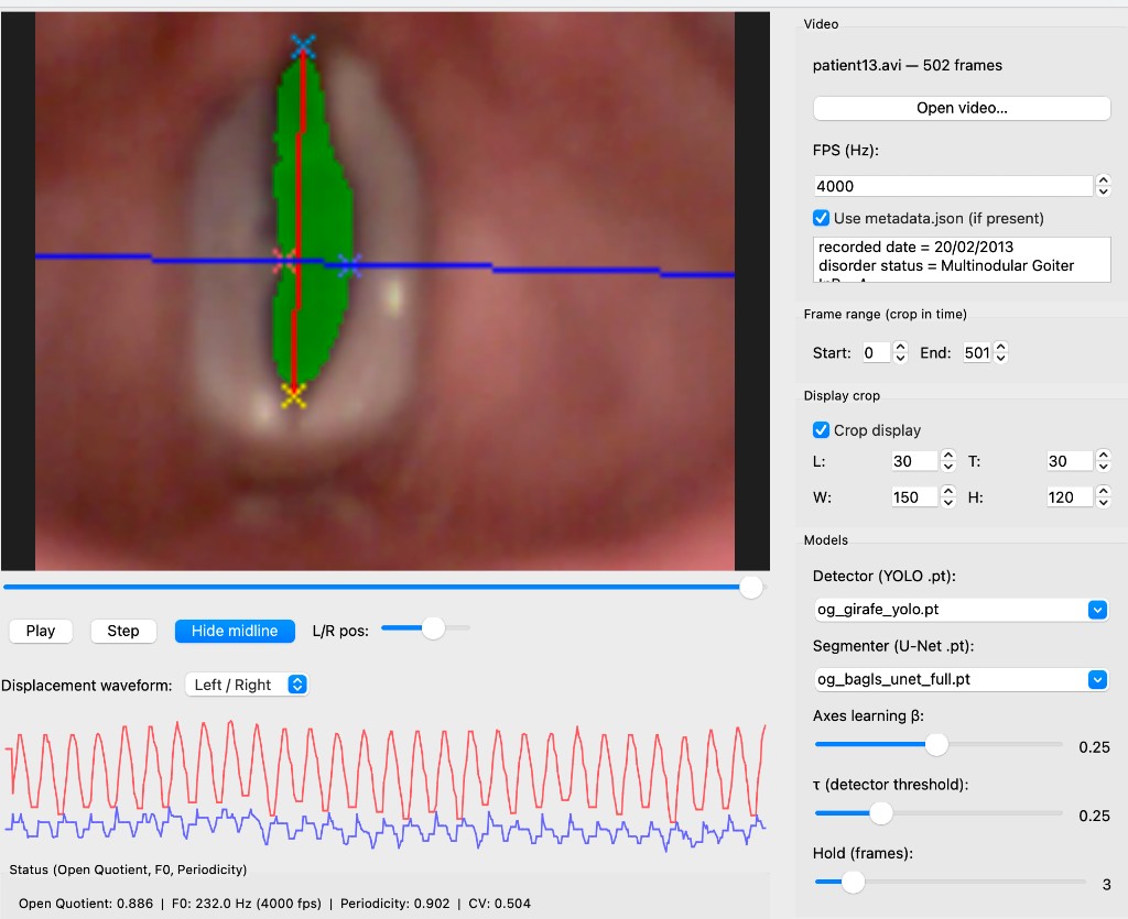 L/R asymmetry in vocal fold nodules