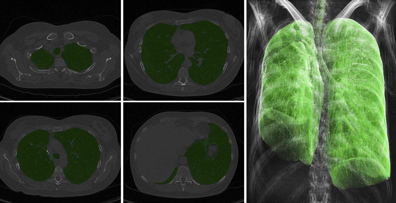 The image contains overlays in lung window settings to check the plausibility of automatically measuring the lung. The axial images (lung window with overlay) and 3D reconstruction show perfect identification of lung parenchyma in a patient after lobectomy.