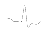 LBBB