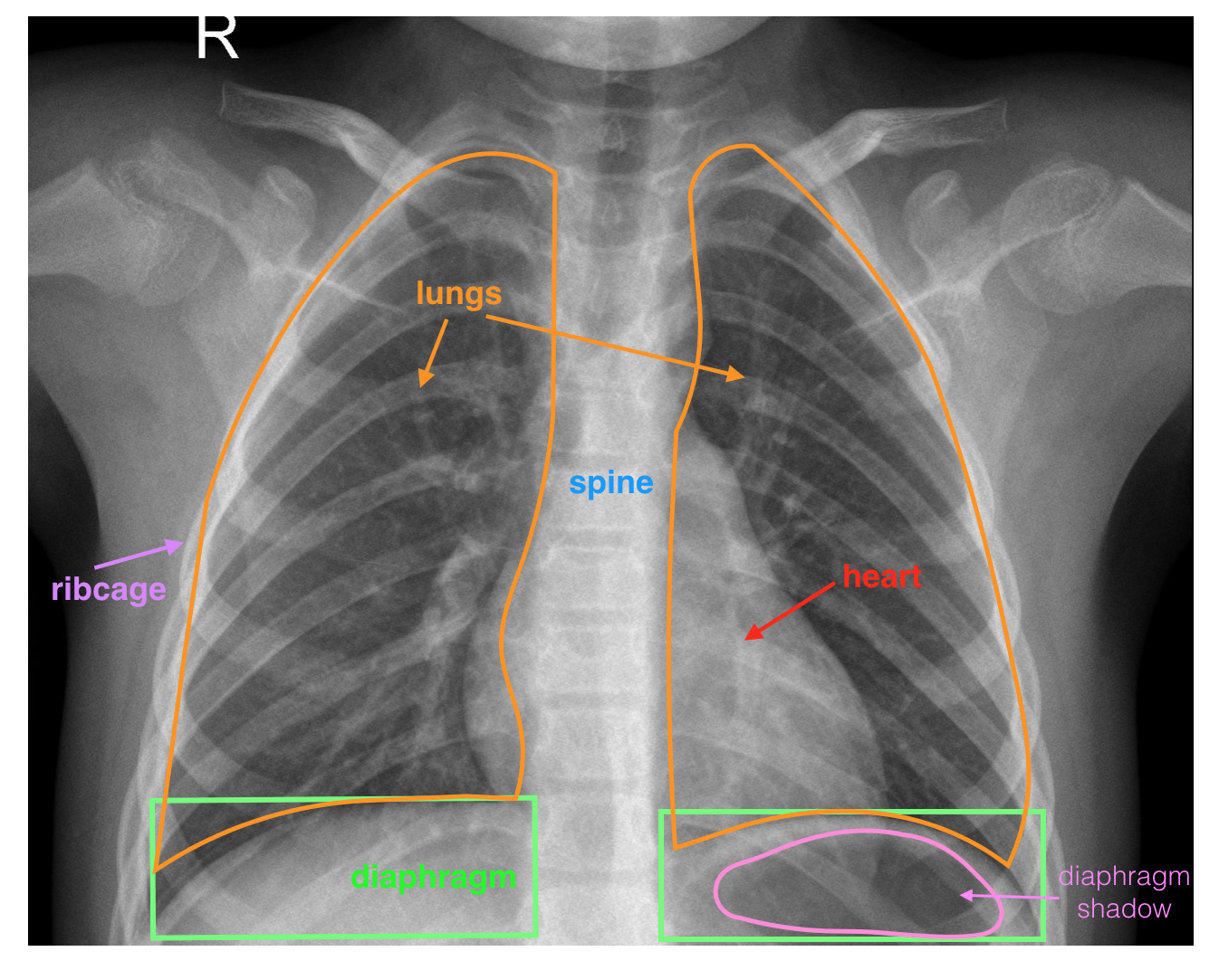 X光胸片医疗影像解读