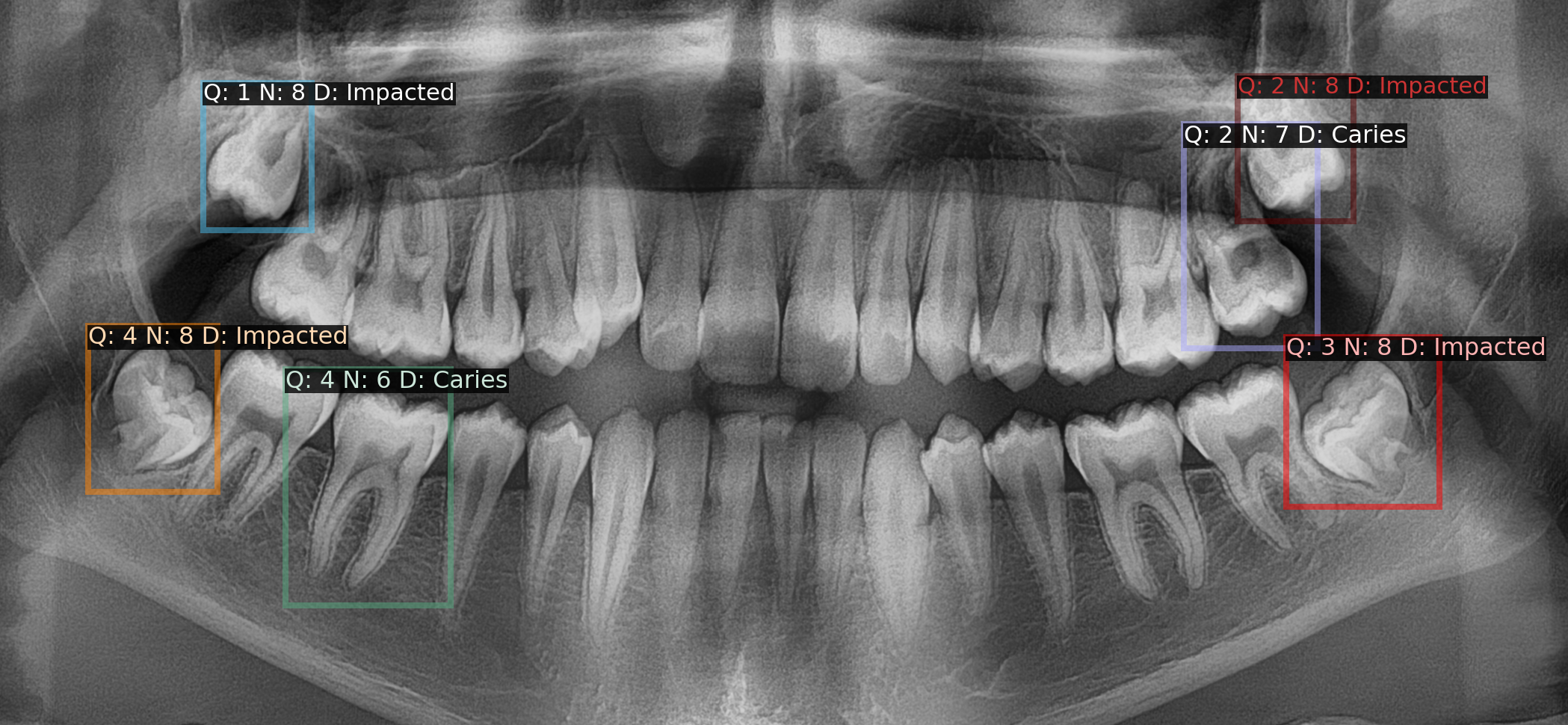 Fig. 1. A desired output from a final algorithm, illustrating well-defined bounding boxes for each abnormal tooth. The corresponding quadrant (Q), enumeration (N), and diagnosis (D) labels are also displayed.