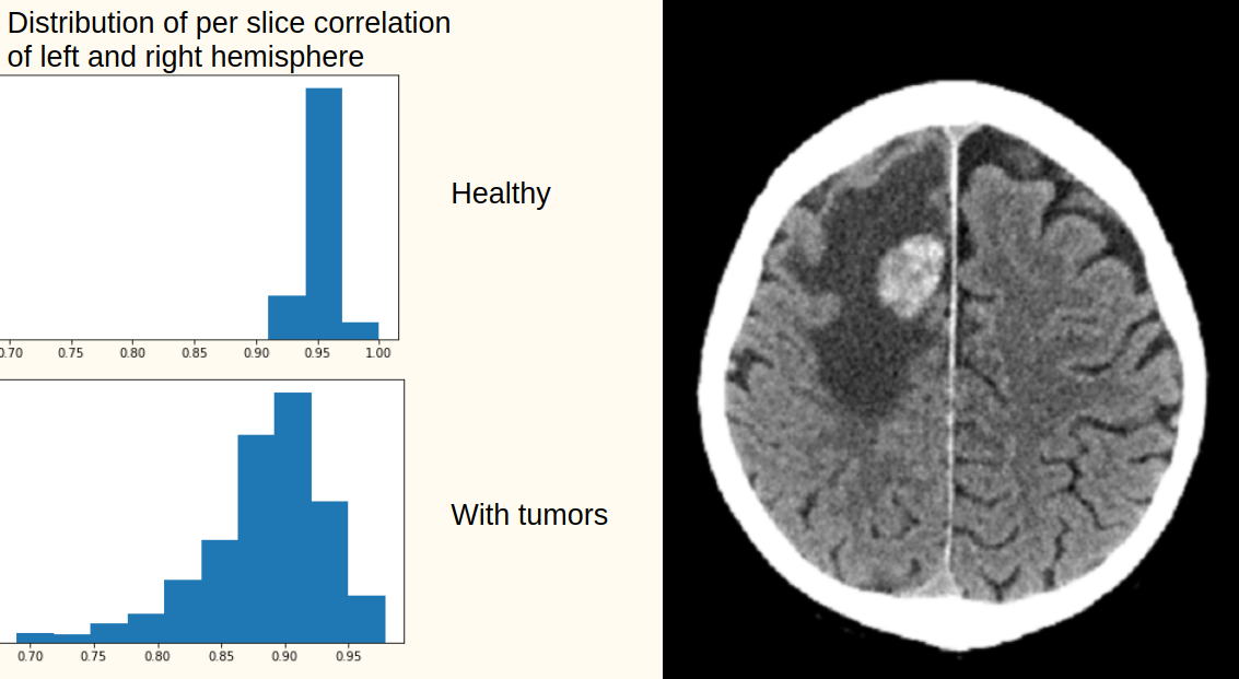 Brain correlation distribution