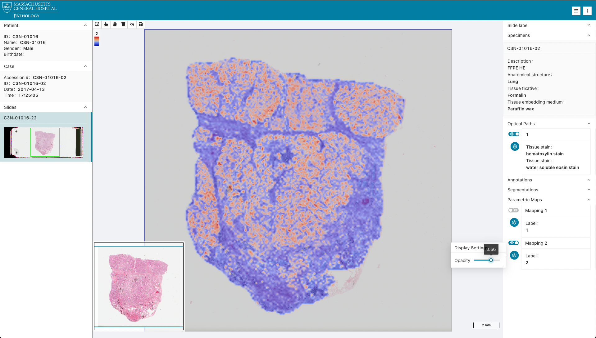 IDC CPTAC Parametric Map