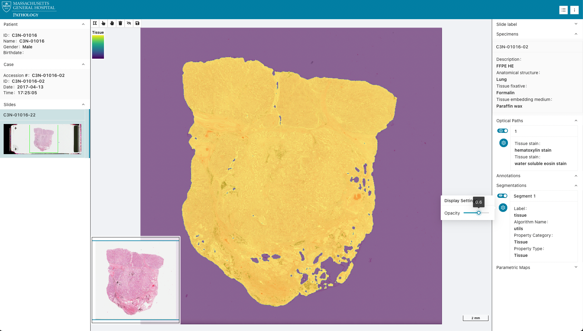 IDC CPTAC Segmentation