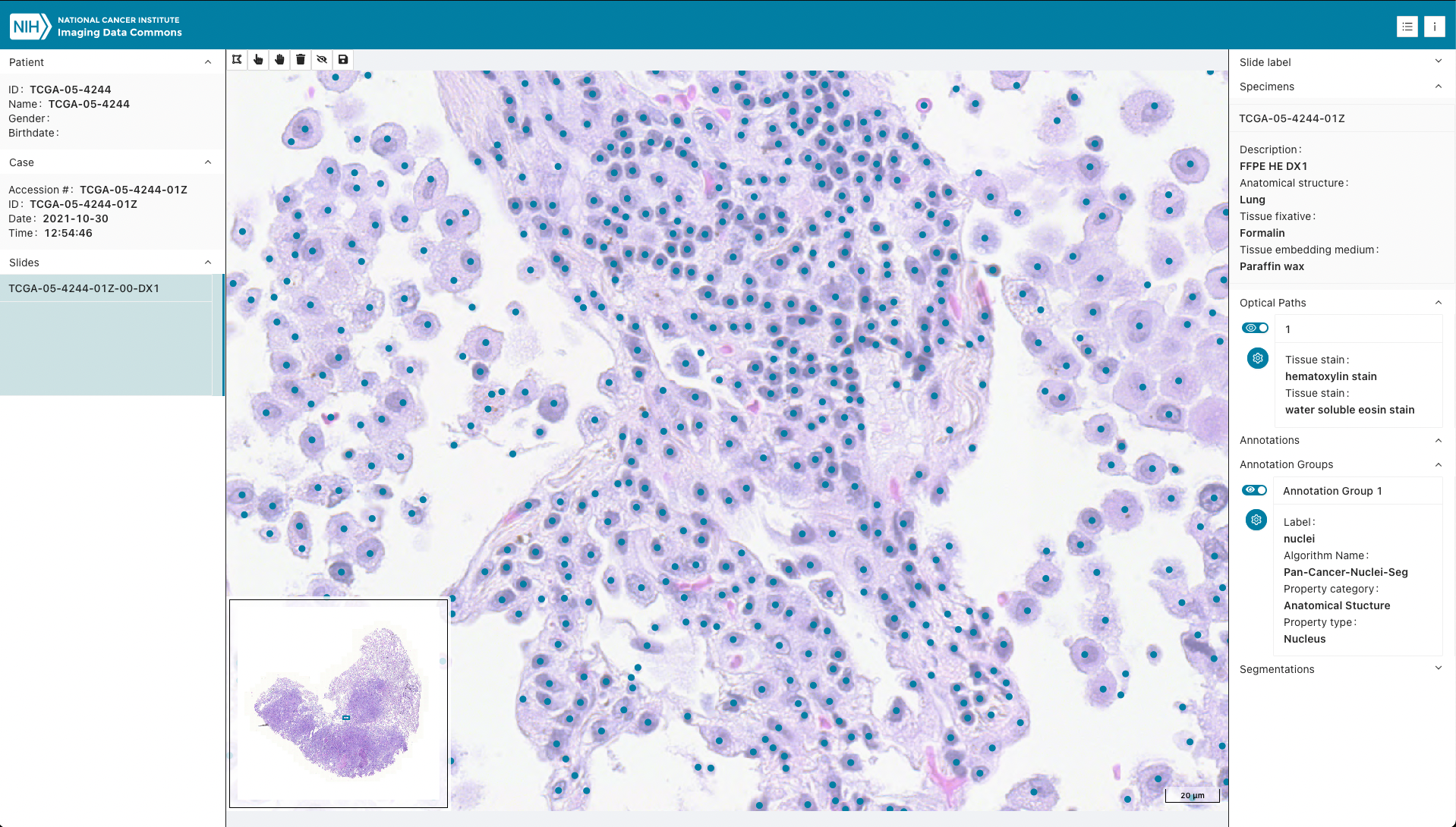 IDC TCGA Segmentation