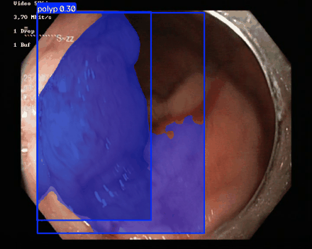 YOLO26-seg segmenting a polyp in a real colonoscopy video