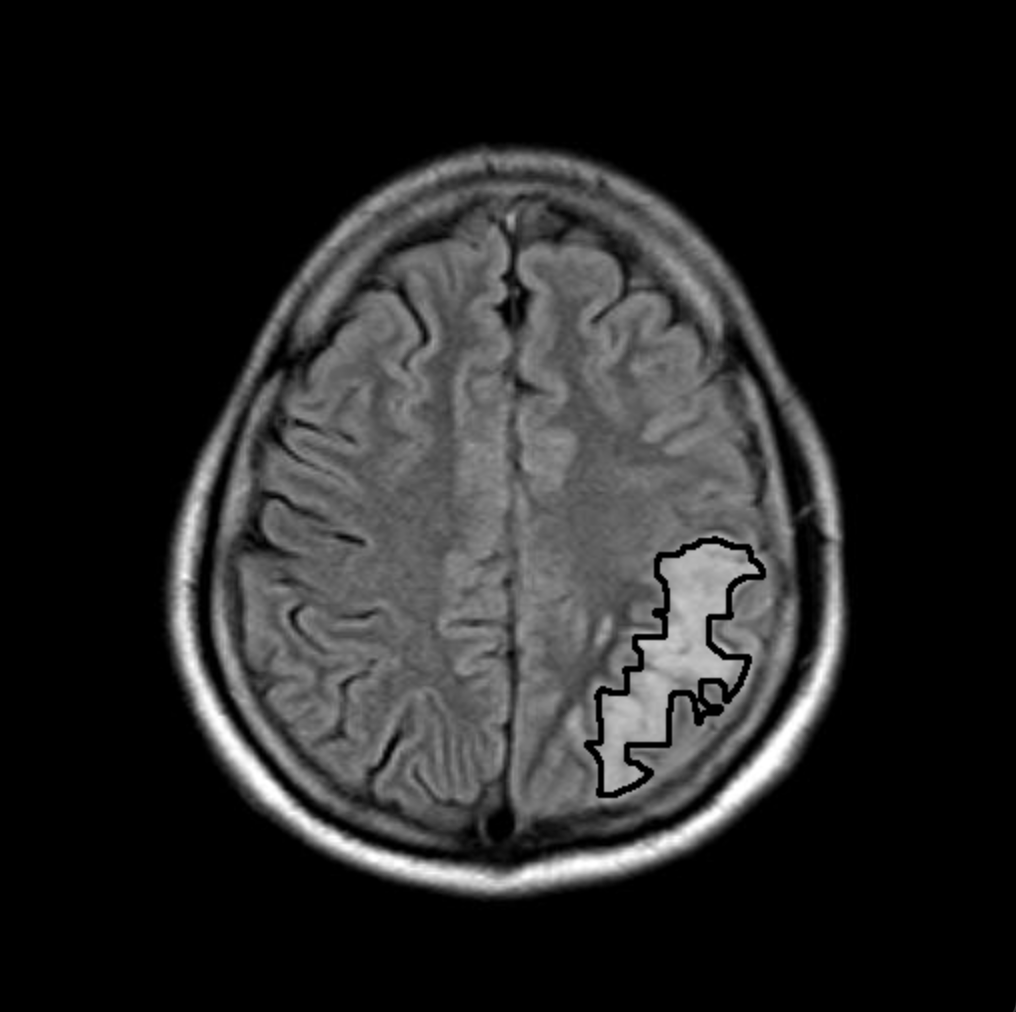 Tumor-Detection Results