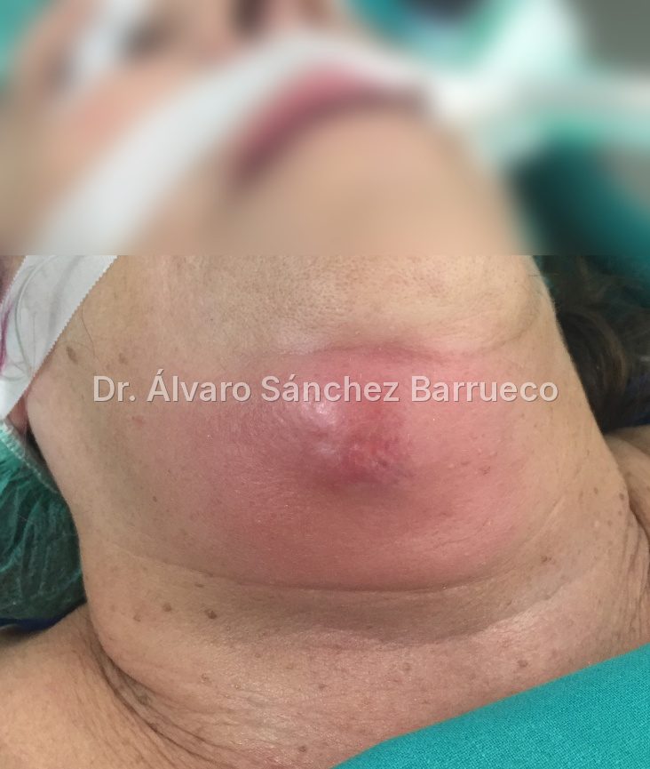 El antibiótico no elimina una piedra ni abre el conducto