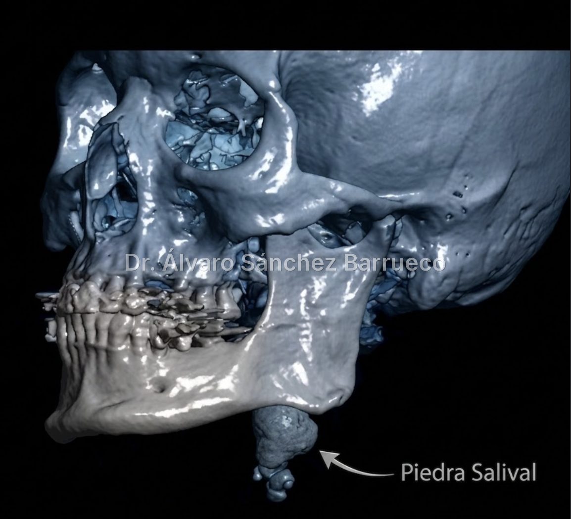 ¿Se puede tratar una litiasis salival grande sin extirpar la glándula?