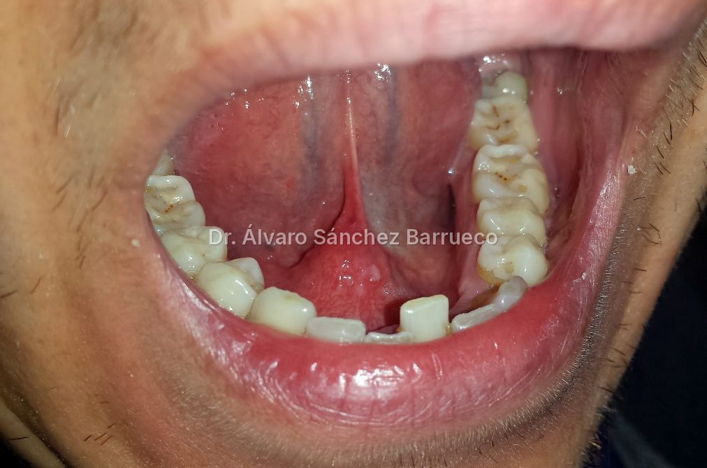 ¿Se puede tratar una litiasis salival grande sin extirpar la glándula?