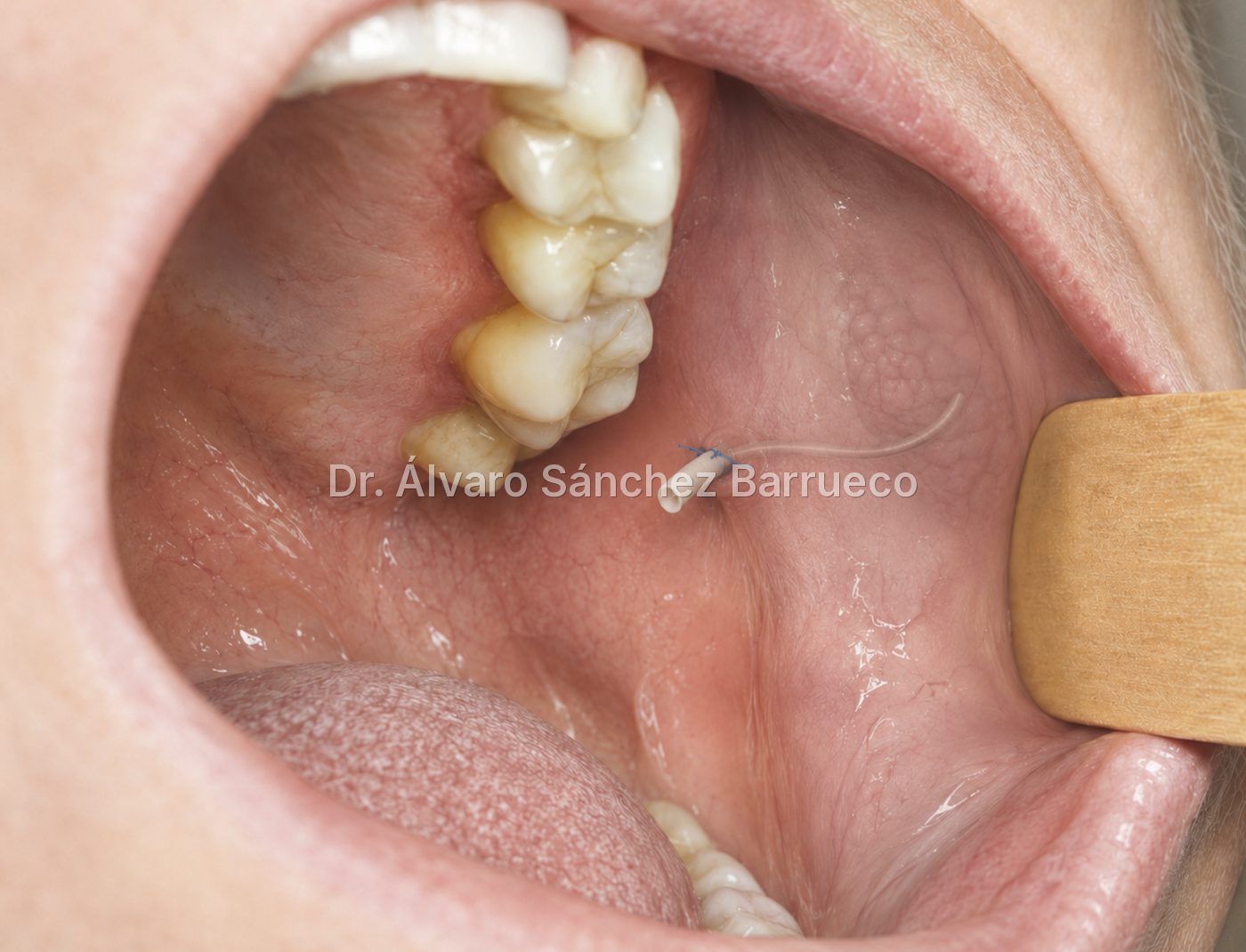 ¿Qué es un stent salival y cuándo se utiliza?