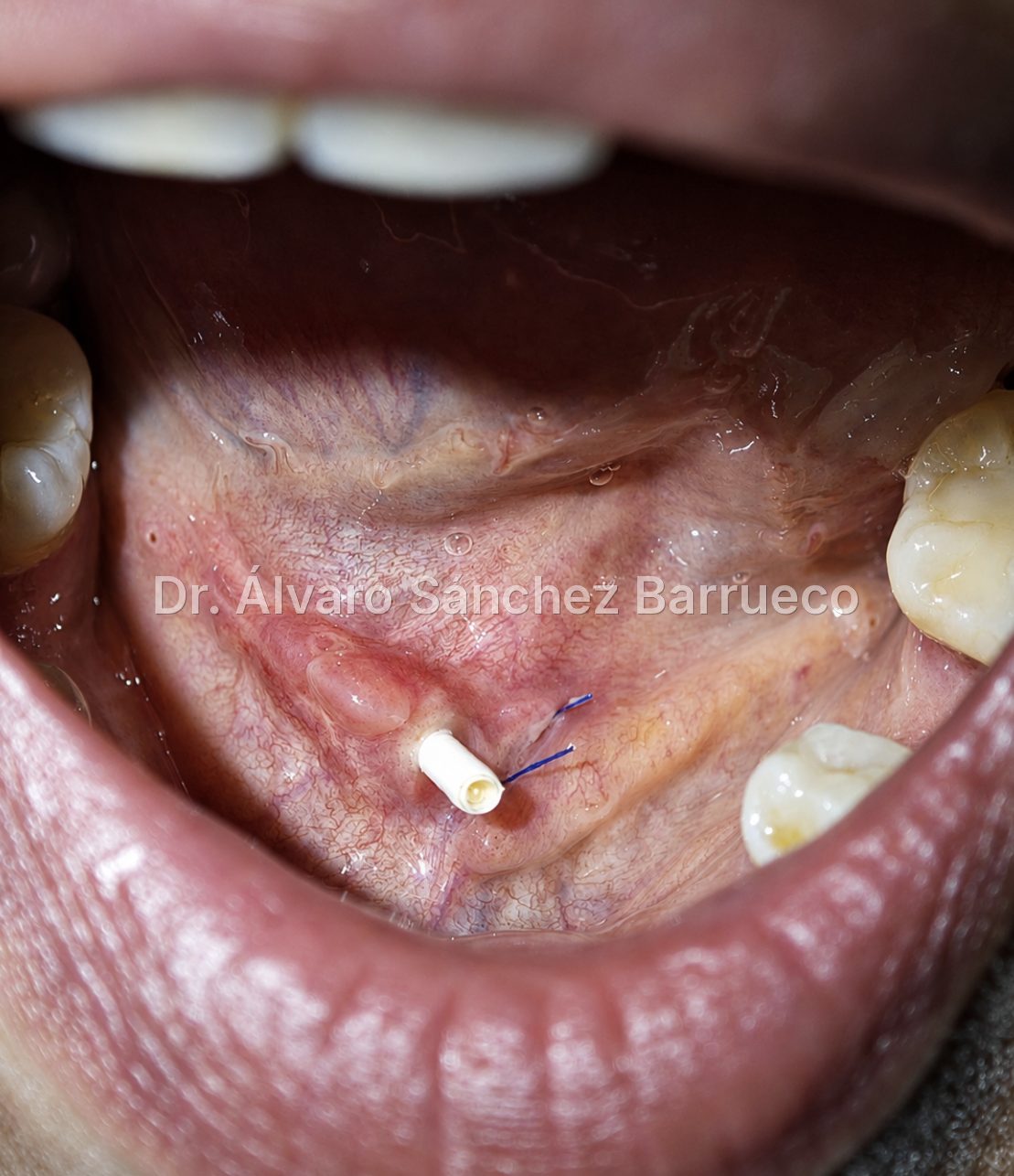 ¿Qué es un stent salival y cuándo se utiliza?